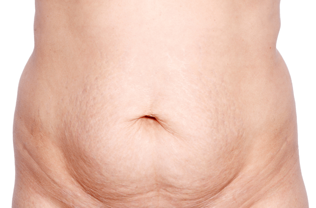 Woman's naked post-partum belly showing loose skin and the belly button illustrating the first signs of diastasis recti or ab separation, also known as mummy tummy