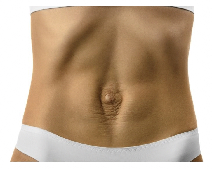Woman's lean, muscled torso illustrating tummy gap from ab separation with diastasis recti around the belly button