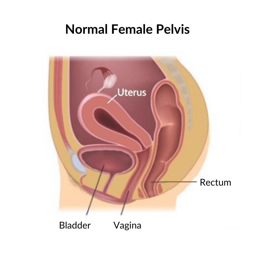 Illustration showing cross-section of woman's normal pelvis including vagina, bladder, urethra, bowel and uterus with no pelvic organ prolapse. 