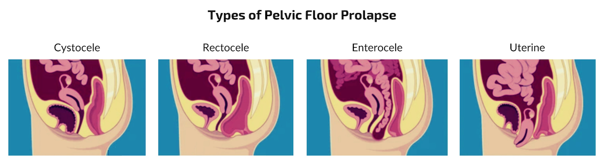 Diagram illustrating four types of pelvic organ prolapse, including cystocele rectocele, enterocele and uterine prolapse.